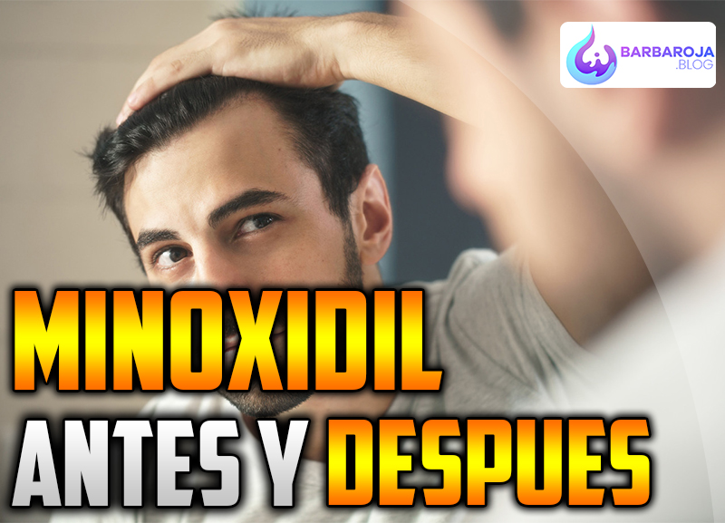 antes y despues minoxidil