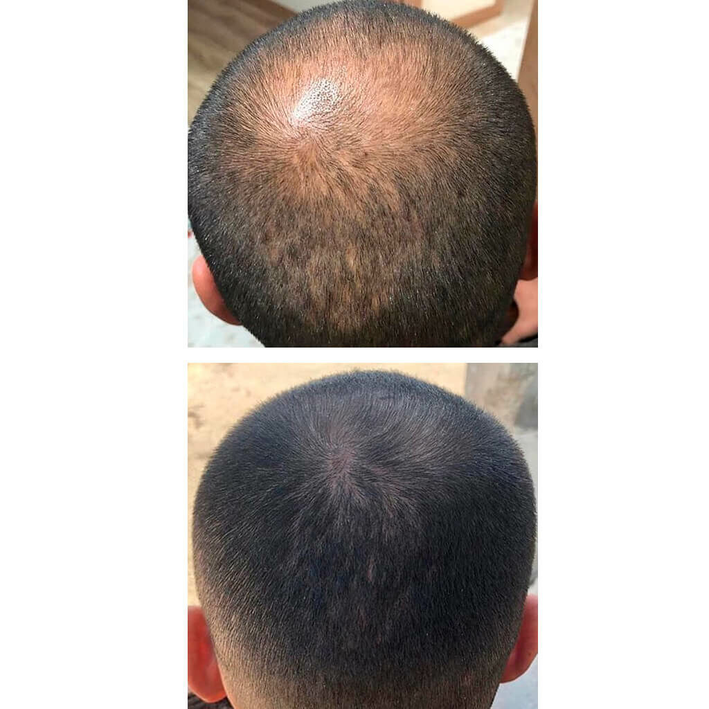 efectividad del minoxidil